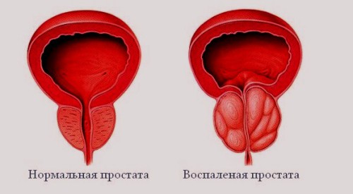 Симптомы простатита 