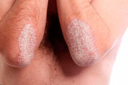 Псориаз Псориаз