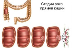 Рак толстой кишки rak