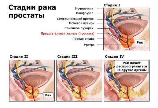 Стадии рака простаты Стадии рака простаты