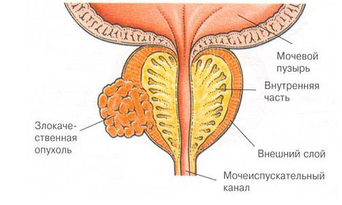 Рак простаты Рак простаты
