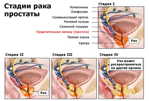 Рак предстательной железы Рак предстательной железы