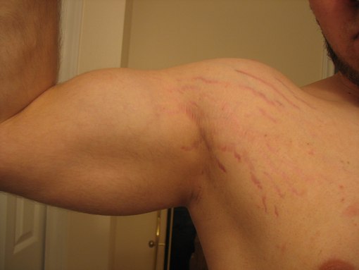 Растяжки на мужских руках Растяжки на мужских руках