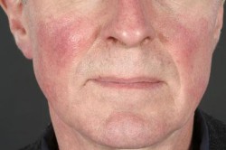 Раздражение кожи Раздражение кожи