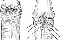 Операция на половом члене Операция на половом члене