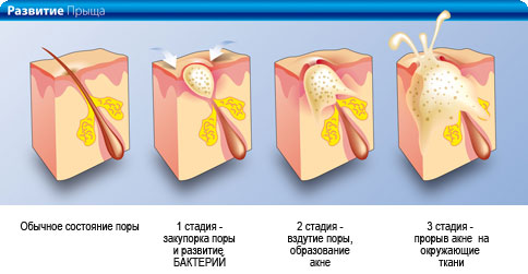 Развитие прыщей Развитие прыщей