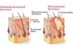 Развитие прыщей в волосяных покровах Развитие прыщей в волосяных покровах