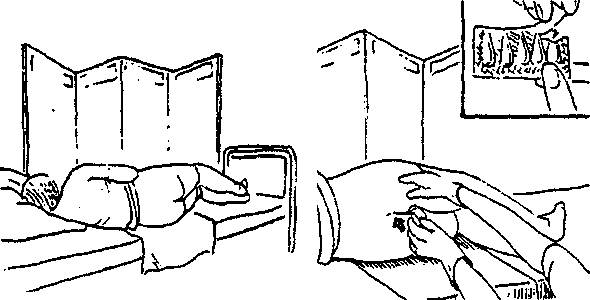 Ректальное введение свечей биопрост Ректальное введение свечей биопрост