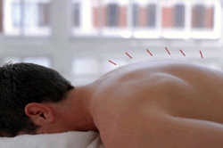 Иглоукалывание Иглоукалывание