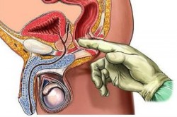 Табакокурение и алкоголь Ректальная диагностика