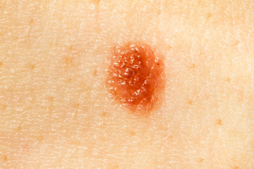 Родинка Родинка