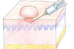 Процесс удаления родинки Процесс удаления родинки