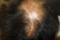 Рубцовая алопеция Рубцовая алопеция