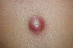 Киста сальной железы