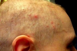Мелкие высыпания на голове Мелкие высыпания на голове