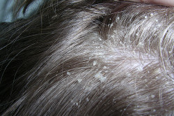 Себорейная алопеция у мужчины Себорейная алопеция у мужчины