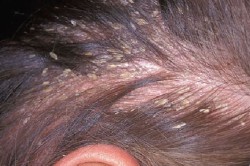 Себорейная алопеция