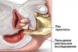 Пальцевое исследование простаты Пальцевое исследование простаты
