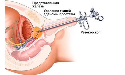 Схема операции ТУРП