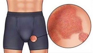 Воспаленная и нормальная простата Воспаленная и нормальная простата