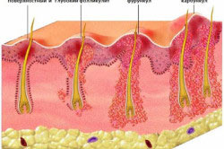 Схема видов фурункула Схема видов фурункула