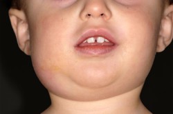 Симптомы паротита у детей и взрослых