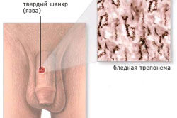 Диагностика сифилиса Диагностика сифилиса