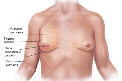 Грудь при гинекомастити Грудь при гинекомастити