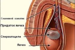 Сперматоцеле Сперматоцеле