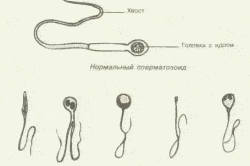 Сравнение нормальных и деформированных сперматозоидов Сравнение нормальных и деформированных сперматозоидов