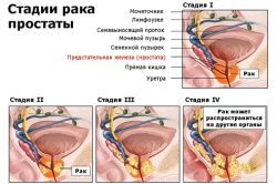 Классификация рака простаты Классификация рака простаты