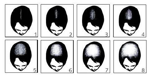 Стадии облысения stadii obliseniy