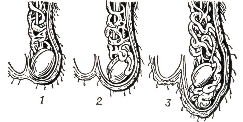 Стадии варикоцеле Стадии варикоцеле