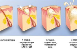 Стадии развития прыща Стадии развития прыща