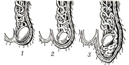 1, 2, 3 стадия варикоцеле 1, 2, 3 стадия варикоцеле