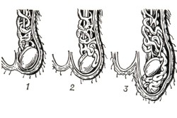 1, 2, 3 стадия варикоцеле 1, 2, 3 стадия варикоцеле