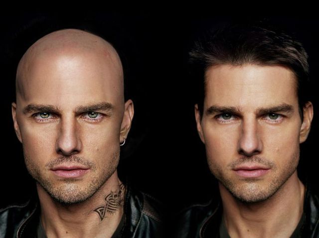 Выпадение волос у мужчин Выпадение волос у мужчин