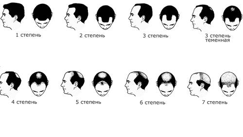 Степени облысения Степени облысения