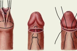 Обрезание при фимозе Обрезание при фимозе