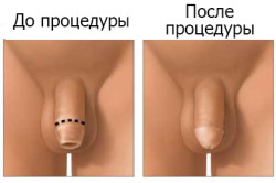 Сужение крайней плоти при фимозе Сужение крайней плоти при фимозе