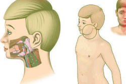 Свинка в подростковом возрасте Свинка в подростковом возрасте