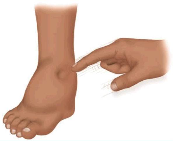 Оттек ног у мужчин Оттек ног у мужчин