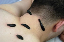 Гирудотерапия