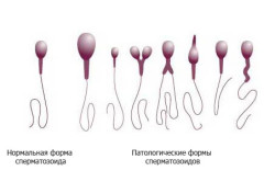 Тератозооспермия