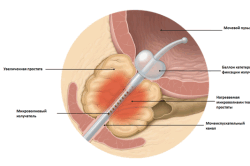 Термотерапия в лечении простатита Термотерапия в лечении простатита