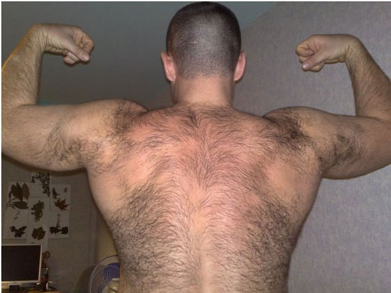 Избыток мужского тестостерона Избыток мужского тестостерона