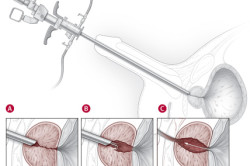 Этапы трансуретральной резекции
