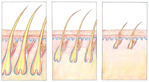 Истощение и выпадение волоса Истощение и выпадение волоса