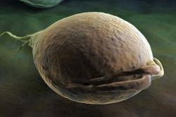 Трихомониаз Трихомониаз