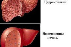 Цирроз печени tsirroz